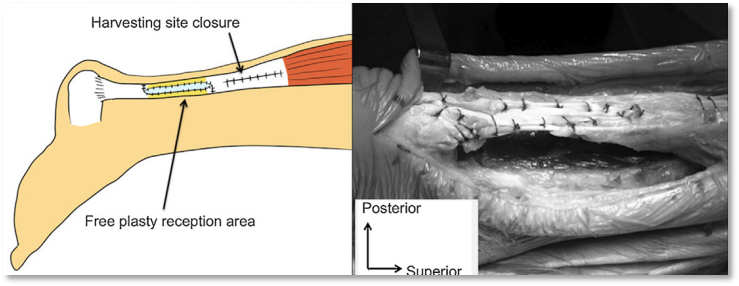 ​图文并茂：慢性跟腱断裂的最新治疗进展