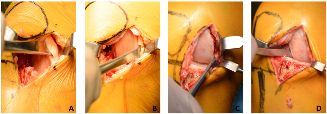 【滑动垫片单髁置换技术精讲系列】第一讲：麻醉、体位