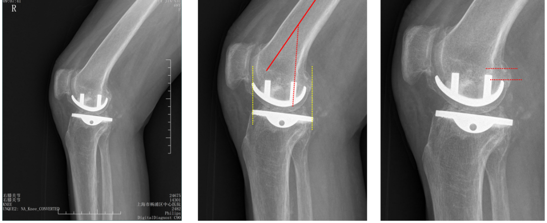 【读懂单髁】从读懂X-ray开始：固定平台单髁假体(LINK®