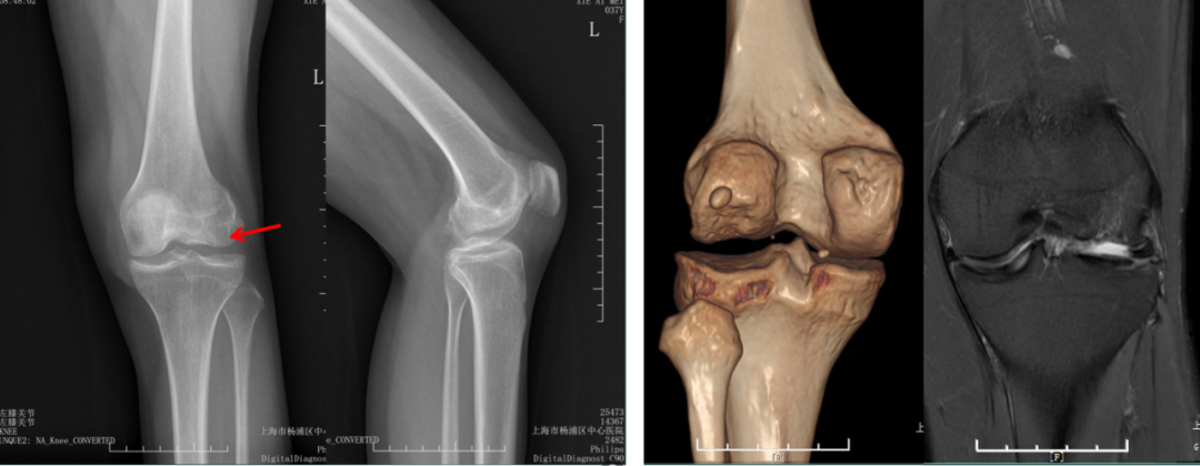 【读懂单髁】从读懂X-ray开始：固定平台单髁假体(SIGMA®