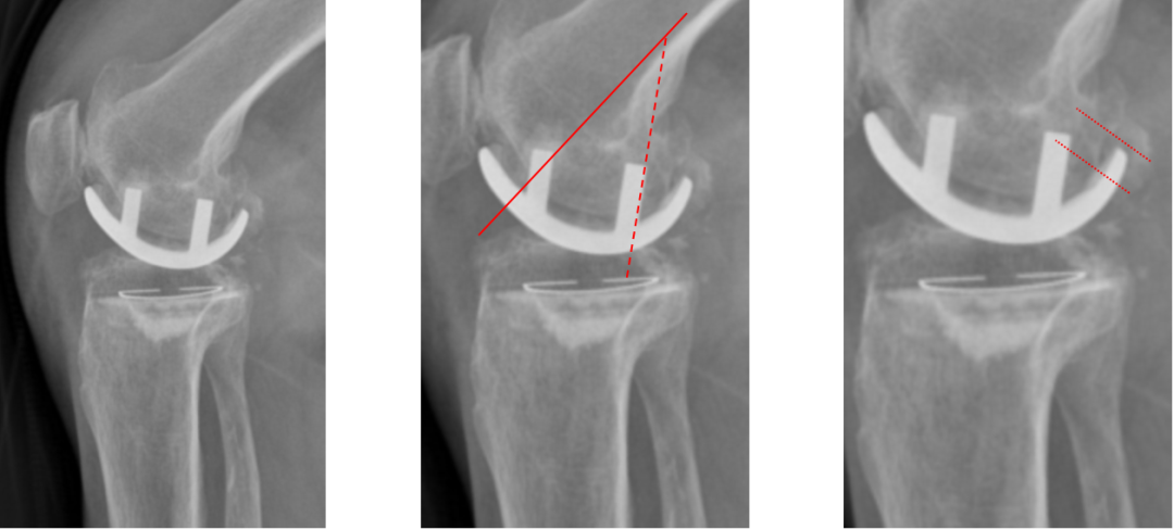 【读懂单髁】从读懂X-ray开始：固定平台单髁假体(LINK®