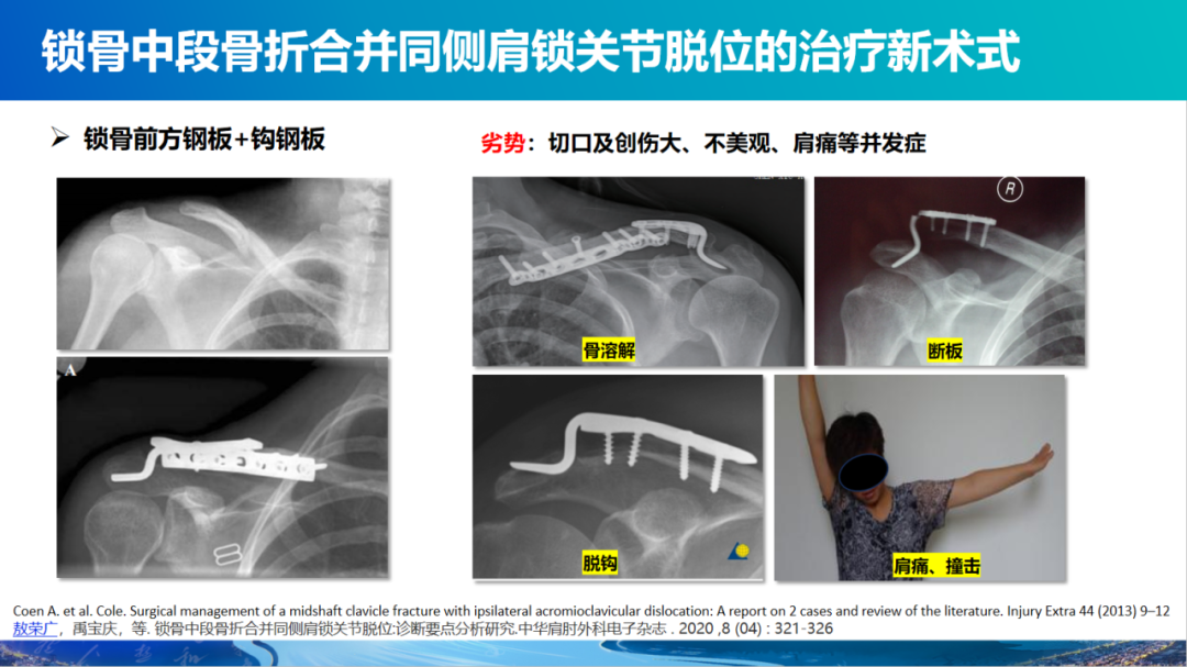 锁骨中段骨折合并同侧肩锁关节脱位新术式：弹性髓内钉+喙锁韧带重建、关节囊缝合