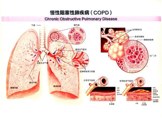 为什么到了夏天慢阻肺更厉害“老来”莫贪凉——夏季预防慢阻肺_https://www.jmylbn.com_新闻资讯_第1张