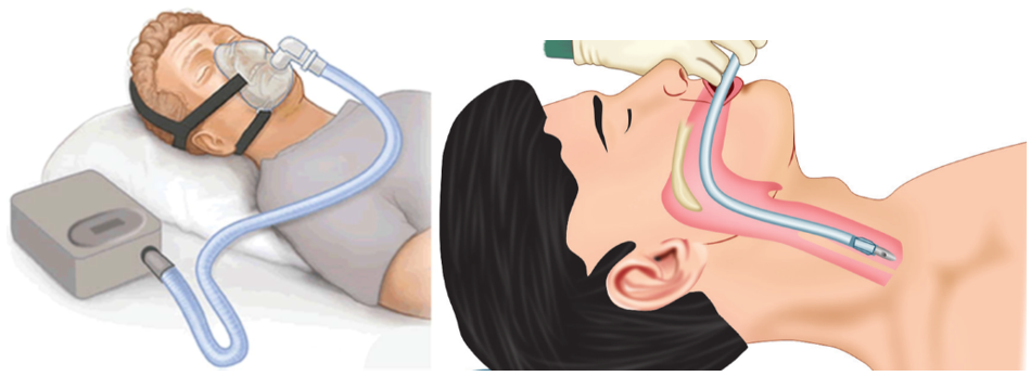 什么是有创呼吸机图片呼吸机：当生命之息受困时的希望之光_https://www.jmylbn.com_新闻资讯_第6张