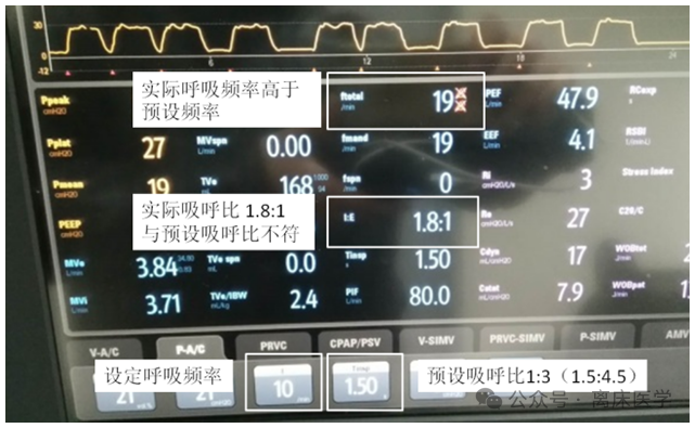 吸呼比怎么调机械通气小王子：呼吸频率、吸呼比_https://www.jmylbn.com_新闻资讯_第14张