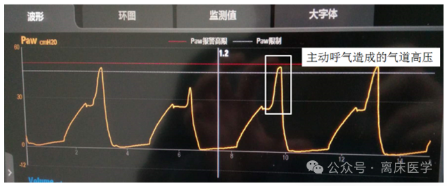 吸呼比怎么调机械通气小王子：呼吸频率、吸呼比_https://www.jmylbn.com_新闻资讯_第15张