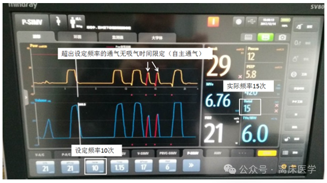 吸呼比怎么调机械通气小王子：呼吸频率、吸呼比_https://www.jmylbn.com_新闻资讯_第6张