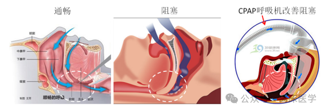 呼吸机f什么意思机械通气小王子：常用无创呼吸机通气模式介绍_https://www.jmylbn.com_新闻资讯_第5张