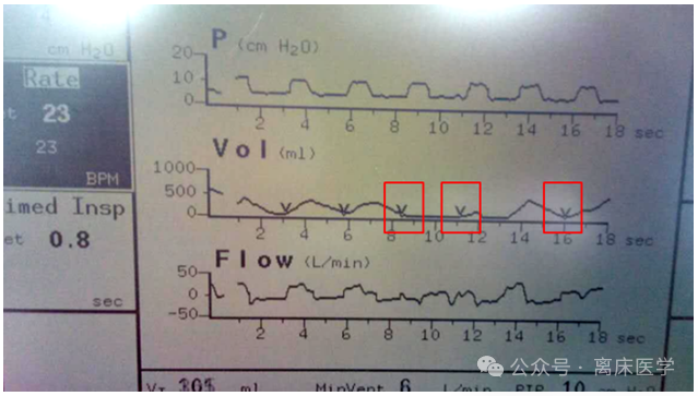 呼吸机f什么意思机械通气小王子：常用无创呼吸机通气模式介绍_https://www.jmylbn.com_新闻资讯_第9张