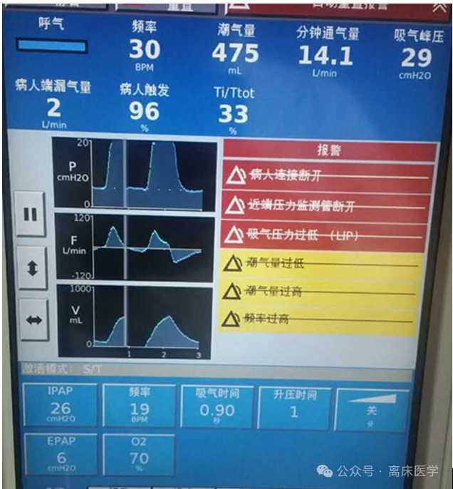 什么是有创呼吸机图片机械通气小王子：无创呼吸机的特点_https://www.jmylbn.com_新闻资讯_第7张