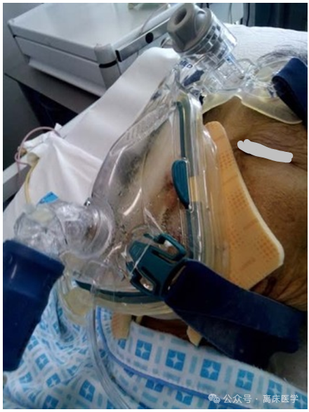 什么是有创呼吸机图片机械通气小王子：无创呼吸机的特点_https://www.jmylbn.com_新闻资讯_第9张