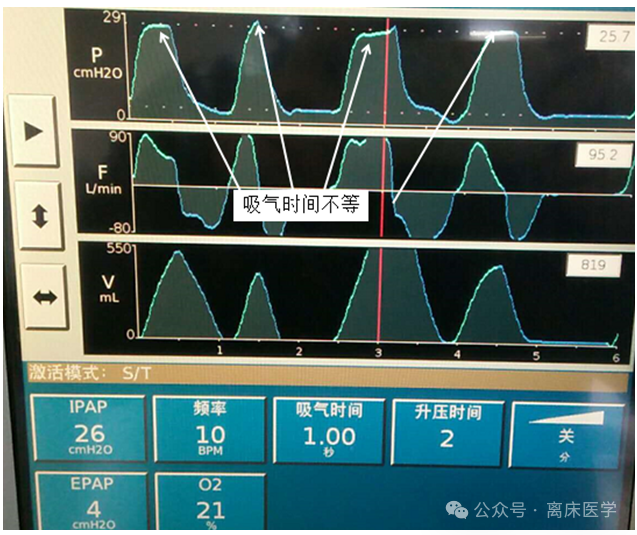 呼吸机f什么意思机械通气小王子：常用无创呼吸机通气模式介绍_https://www.jmylbn.com_新闻资讯_第13张