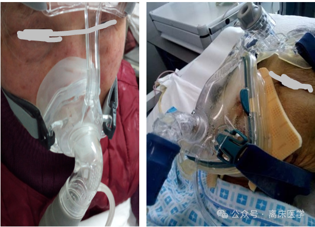 什么是有创呼吸机图片机械通气小王子：无创呼吸机的特点_https://www.jmylbn.com_新闻资讯_第8张