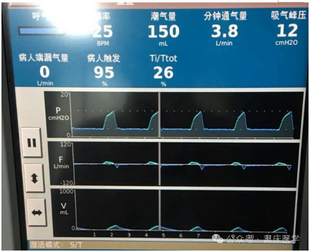 什么是有创呼吸机图片机械通气小王子：无创呼吸机的特点_https://www.jmylbn.com_新闻资讯_第6张