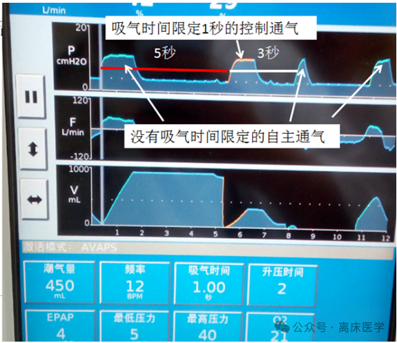 呼吸机f什么意思机械通气小王子：常用无创呼吸机通气模式介绍_https://www.jmylbn.com_新闻资讯_第8张