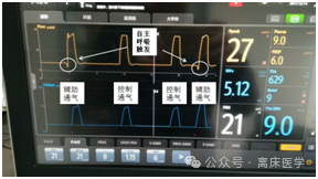 呼吸机怎么看自主呼吸机械通气小白：五种基本机械通气模式_https://www.jmylbn.com_新闻资讯_第13张