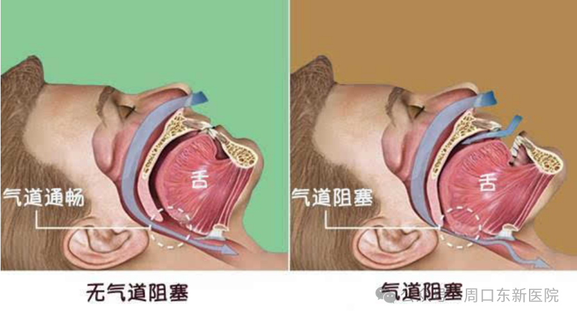 呼吸睡眠监测仪怎么用周口东新医院耳鼻喉科3.21“世界睡眠日”推出睡眠呼吸监测半价活动_https://www.jmylbn.com_新闻资讯_第10张
