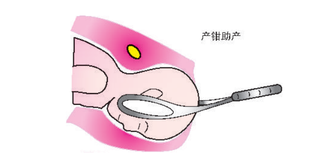 kielland产钳怎么翻译阴道助产前的全面评估与方法_https://www.jmylbn.com_新闻资讯_第2张