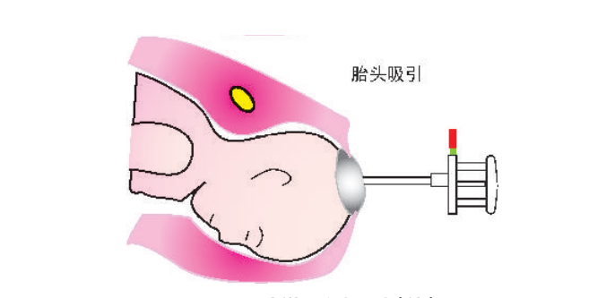 kielland产钳怎么翻译阴道助产前的全面评估与方法_https://www.jmylbn.com_新闻资讯_第3张