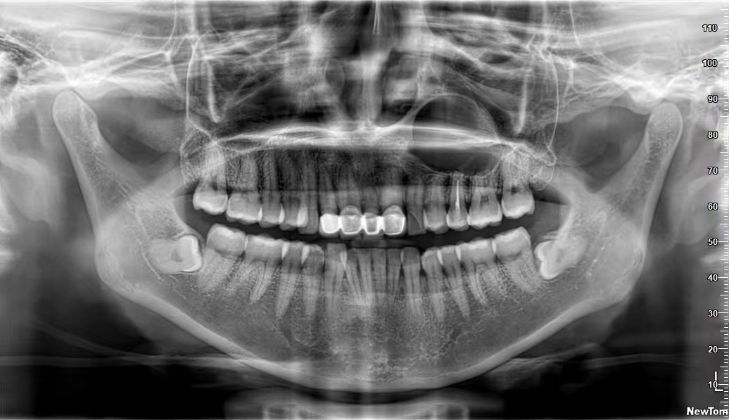 曲面断层片怎么看【健康资讯】看牙为什么要拍片？_https://www.jmylbn.com_新闻资讯_第5张