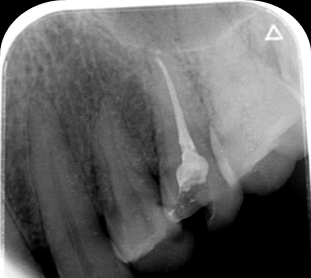 曲面断层片怎么看【健康资讯】看牙为什么要拍片？_https://www.jmylbn.com_新闻资讯_第9张