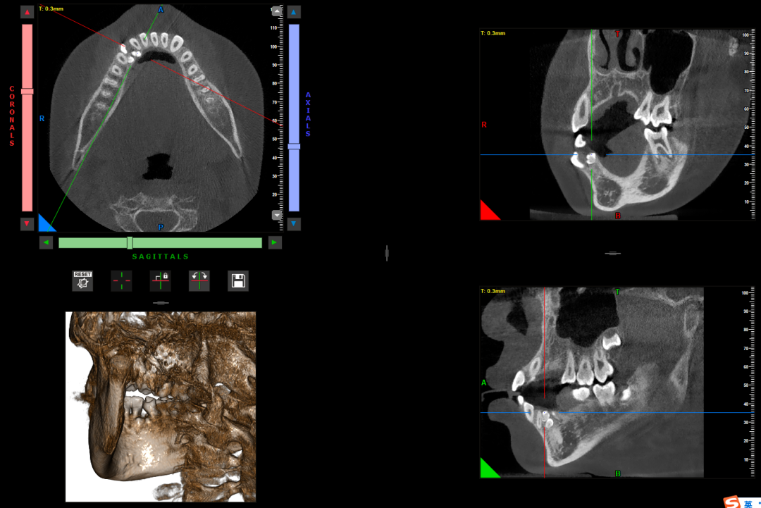 曲面断层片怎么看【健康资讯】看牙为什么要拍片？_https://www.jmylbn.com_新闻资讯_第11张