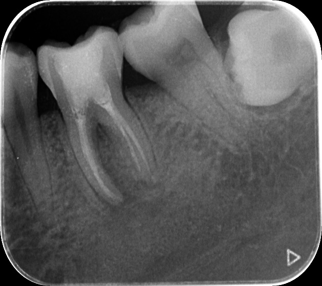 曲面断层片怎么看【健康资讯】看牙为什么要拍片？_https://www.jmylbn.com_新闻资讯_第8张