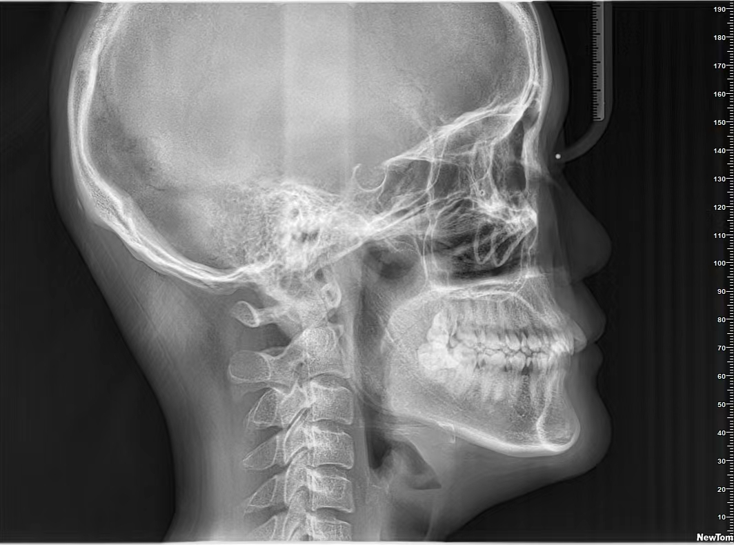 曲面断层片怎么看【健康资讯】看牙为什么要拍片？_https://www.jmylbn.com_新闻资讯_第7张