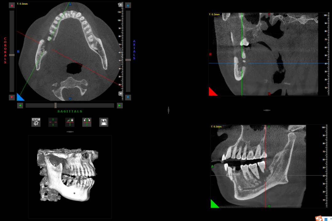 曲面断层片怎么看【健康资讯】看牙为什么要拍片？_https://www.jmylbn.com_新闻资讯_第10张