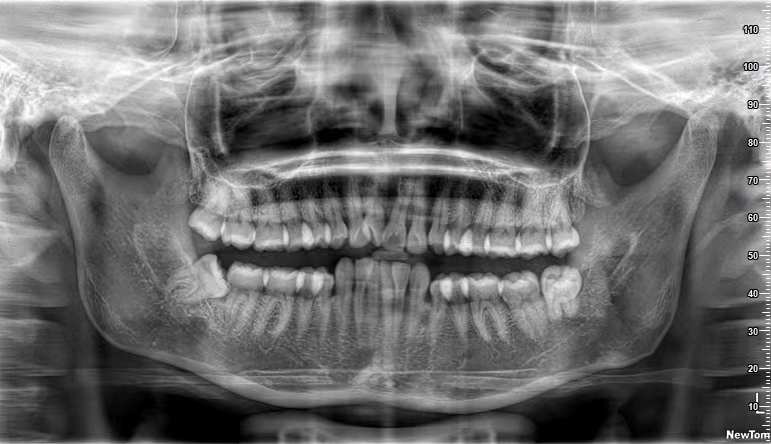 曲面断层片怎么看【健康资讯】看牙为什么要拍片？_https://www.jmylbn.com_新闻资讯_第4张