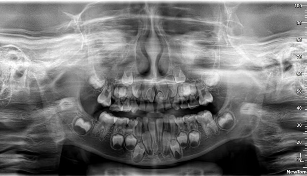 曲面断层片怎么看【健康资讯】看牙为什么要拍片？_https://www.jmylbn.com_新闻资讯_第6张