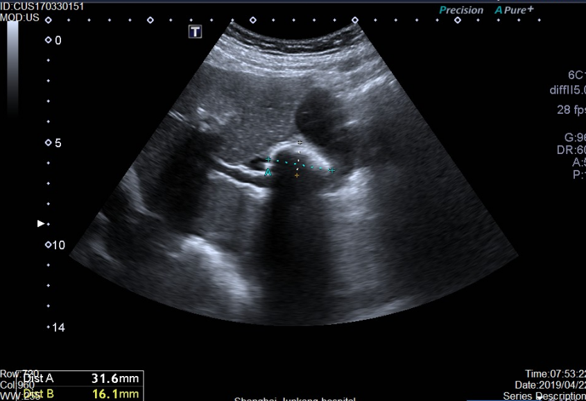 胆囊炎可以自愈吗 影视聚合站