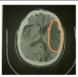 腦梗為什麼得病那麼急？哪類人容易得腦梗？ 健康 第2張