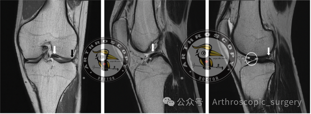 【手术理念】桶柄样撕裂，别只看矢状位