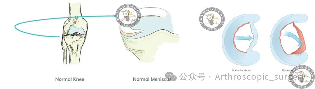【手术理念】桶柄样撕裂，别只看矢状位