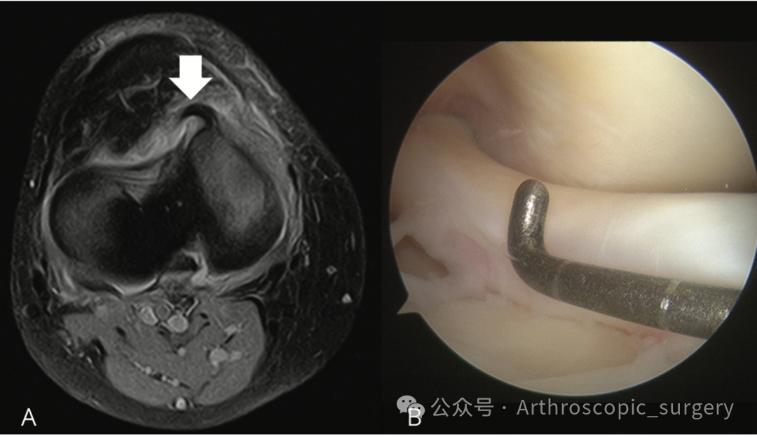 【手术理念】桶柄样撕裂，别只看矢状位