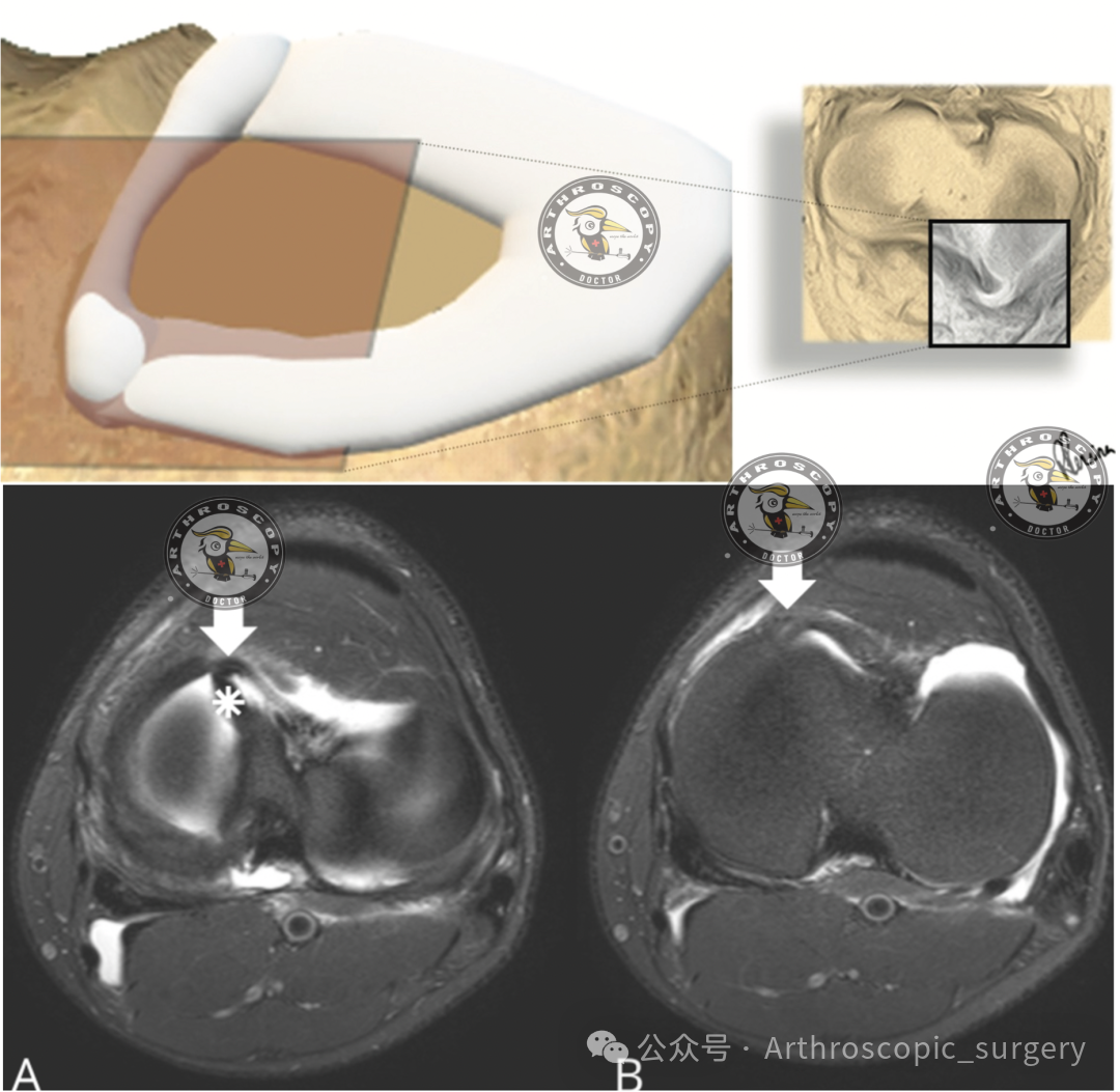 【手术理念】桶柄样撕裂，别只看矢状位
