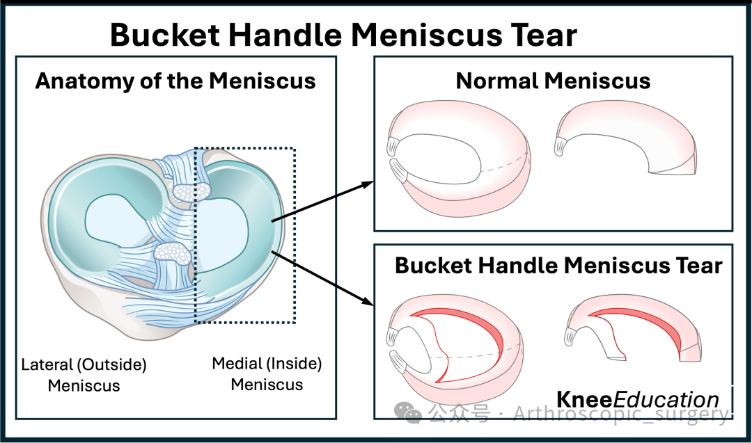 【手术理念】桶柄样撕裂，别只看矢状位