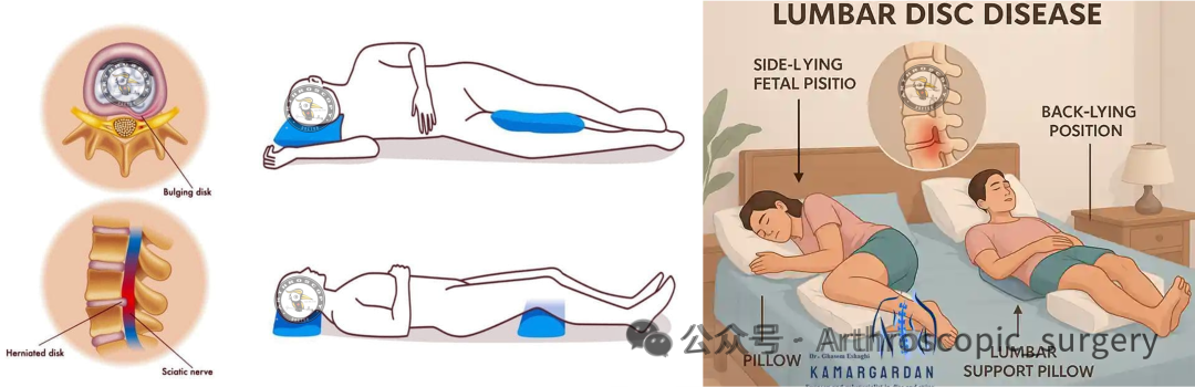 腰椎间盘突出症运动康复的专家共识（2025年）