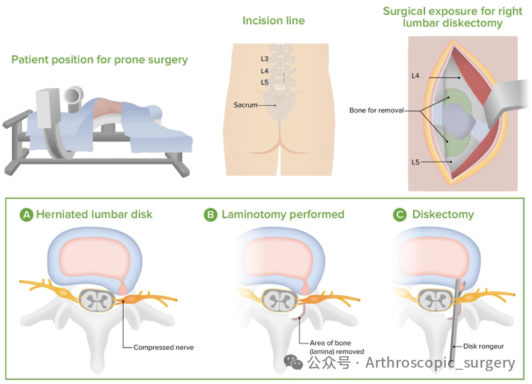 腰椎间盘突出症运动康复的专家共识（2025年）