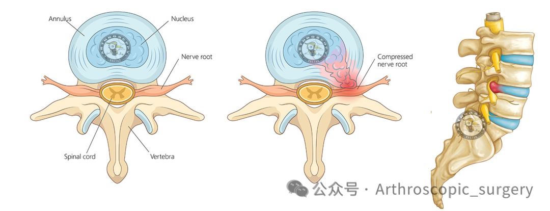 腰椎间盘突出症运动康复的专家共识（2025年）