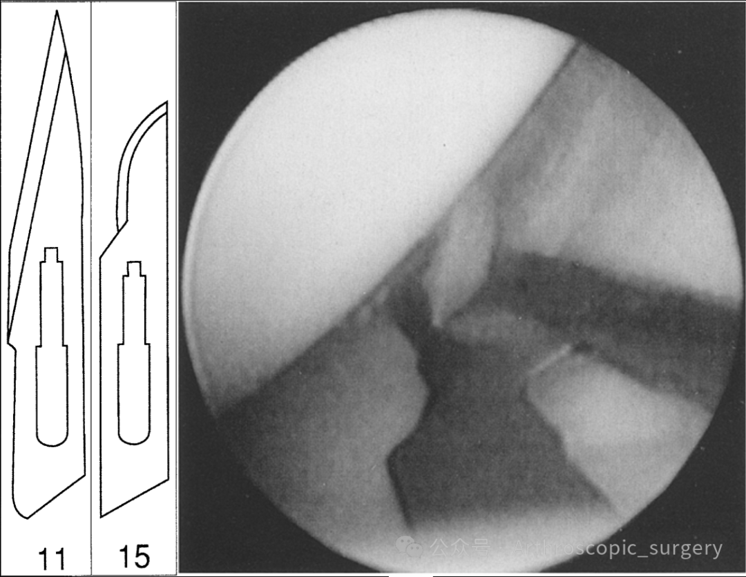 手术刀怎么换刀片骨科精读 ｜ 关节镜切口该用几号刀片？细节要注意好！_https://www.jmylbn.com_新闻资讯_第5张