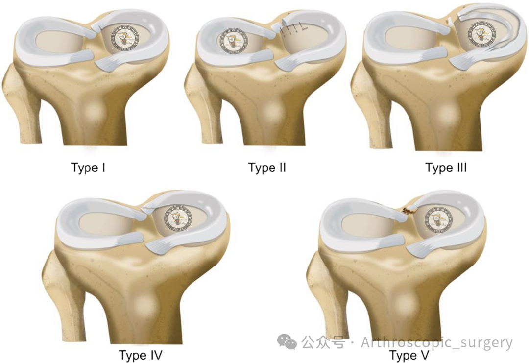 【它山之石】国际专家共识：内侧半月板根部撕裂的诊断、治疗和康复（2025年）