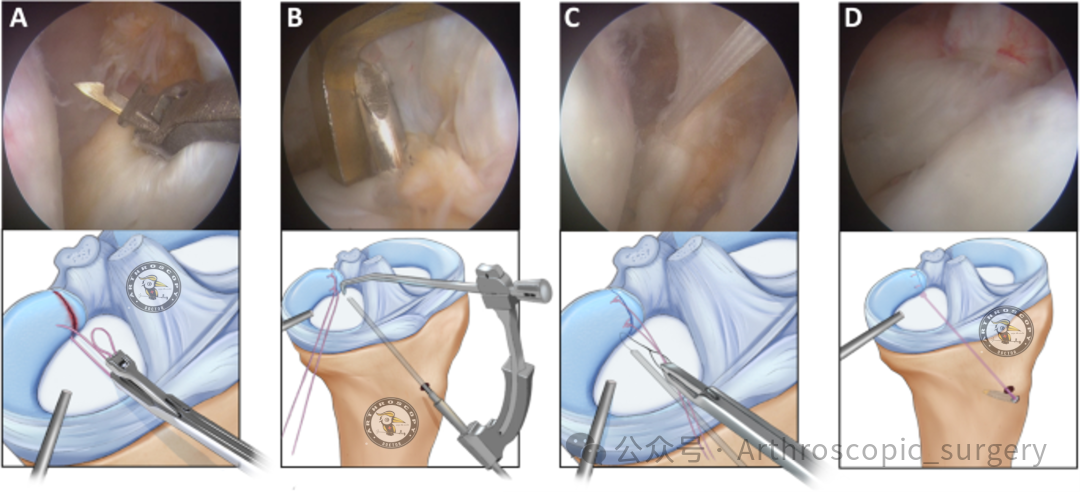 【它山之石】国际专家共识：内侧半月板根部撕裂的诊断、治疗和康复（2025年）