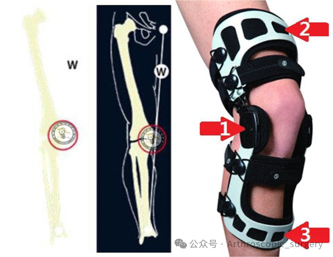 【它山之石】国际专家共识：内侧半月板根部撕裂的诊断、治疗和康复（2025年）