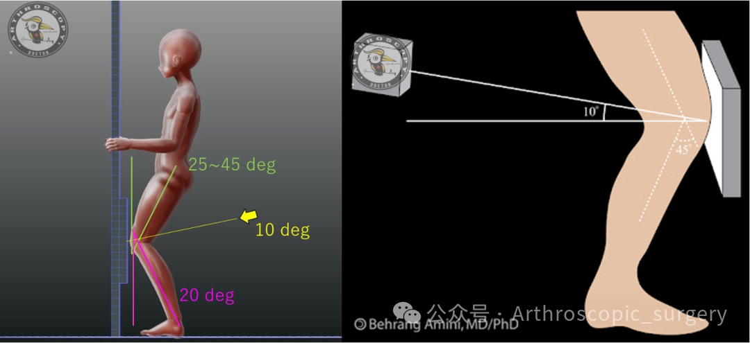 【它山之石】国际专家共识：内侧半月板根部撕裂的诊断、治疗和康复（2025年）