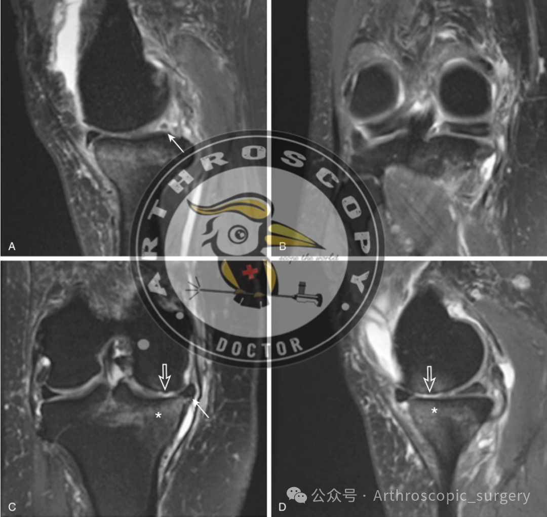 【它山之石】国际专家共识：内侧半月板根部撕裂的诊断、治疗和康复（2025年）