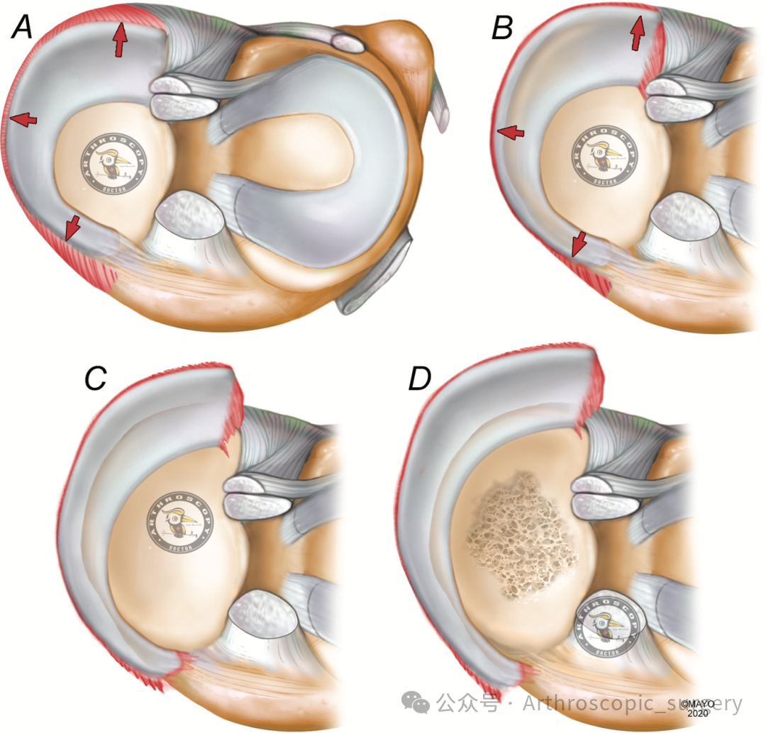 【它山之石】国际专家共识：内侧半月板根部撕裂的诊断、治疗和康复（2025年）