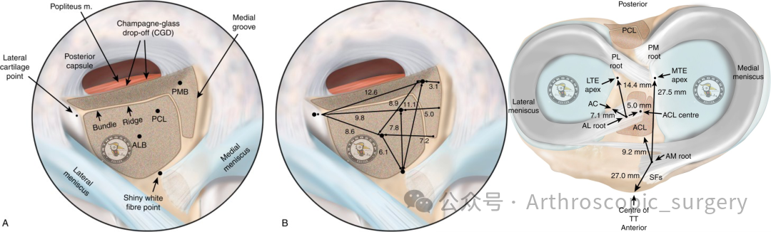 【它山之石】国际专家共识：内侧半月板根部撕裂的诊断、治疗和康复（2025年）