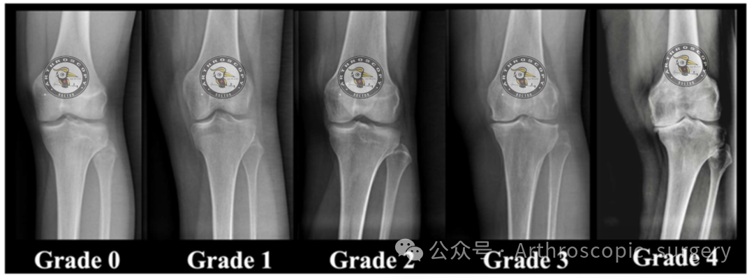 【它山之石】国际专家共识：内侧半月板根部撕裂的诊断、治疗和康复（2025年）